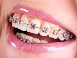 zęby a leczenie ortodoncją