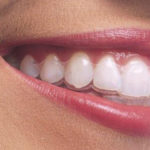 Zabiegi stomatologii estetycznej – sposób na zdrowy i piękny uśmiech aparat-150x150