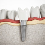 Jak wygląda implant zębowy?