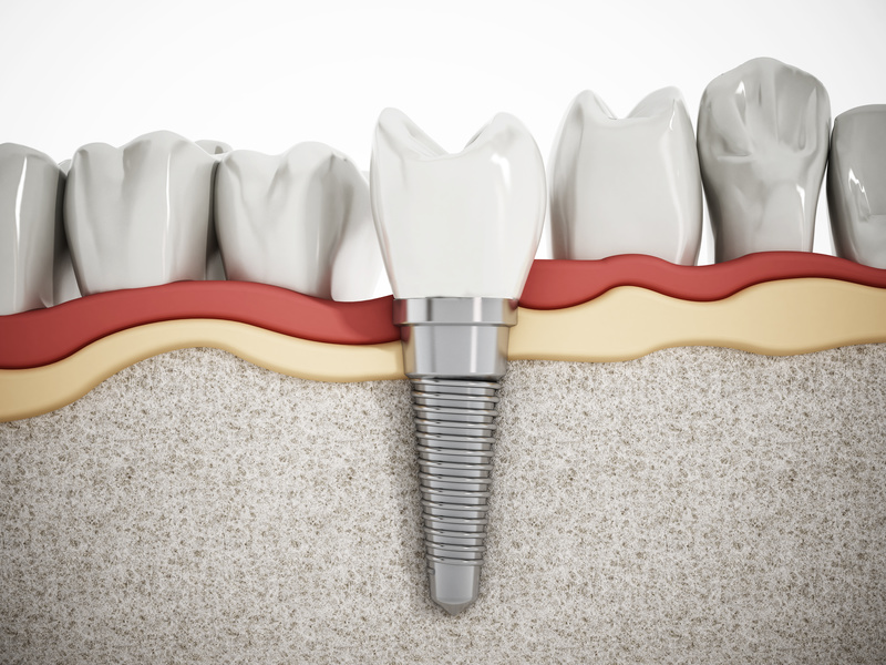 Co warto wiedzieć o implantach zębowych Fotolia_101784645_S-1
