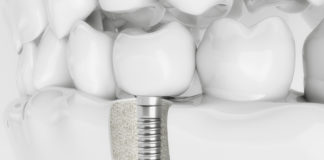 Implanty - metoda na brak zębów