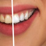 Zabiegi stomatologii estetycznej – sposób na zdrowy i piękny uśmiech licówki-przed-po-150x150