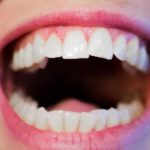 Licówki kompozytowe - korekcja zębów
