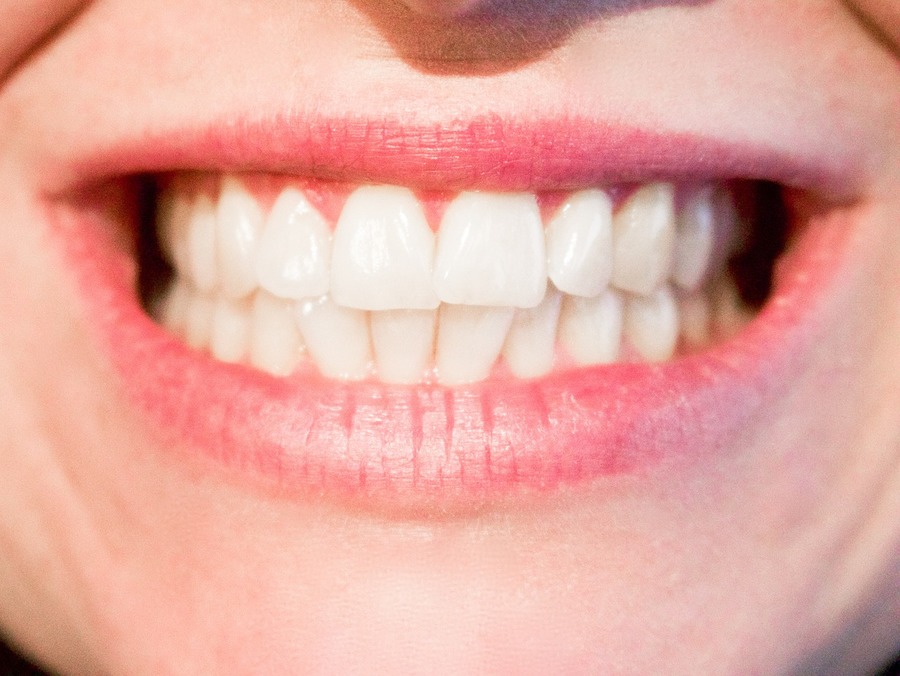 Licówki na zęby- jak o nie dbać i czy warto zainwestować? piekne-biale-zeby-kobieta