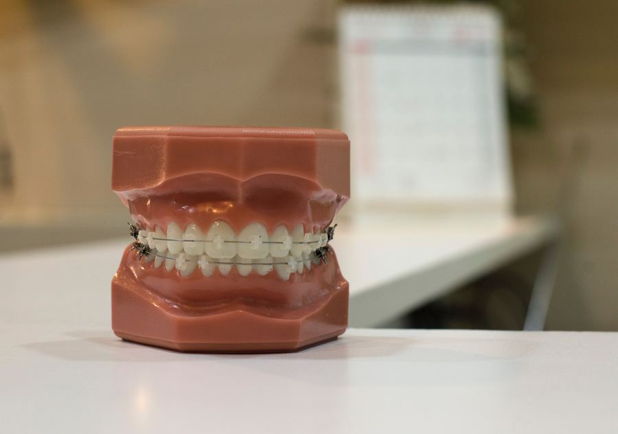 Dlaczego warto zainwestować w aparat ortodontyczny? Jak szybko widać efekty? szczeka-zeby