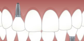 Stomatologia teeth-3597679_1280-324x160