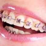 zęby a leczenie ortodoncją