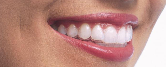 aparat Invisalign